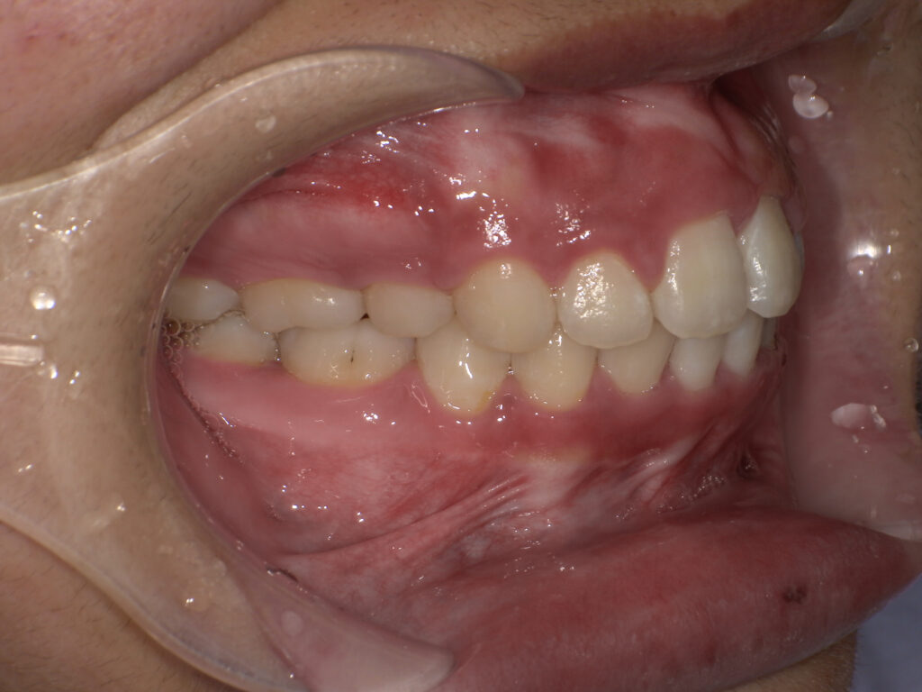 すきっ歯の症例（ワイヤー矯正・術後・側貌）