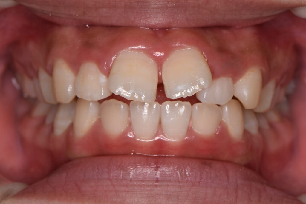 すきっ歯の症例（ワイヤー矯正・術前・正面）