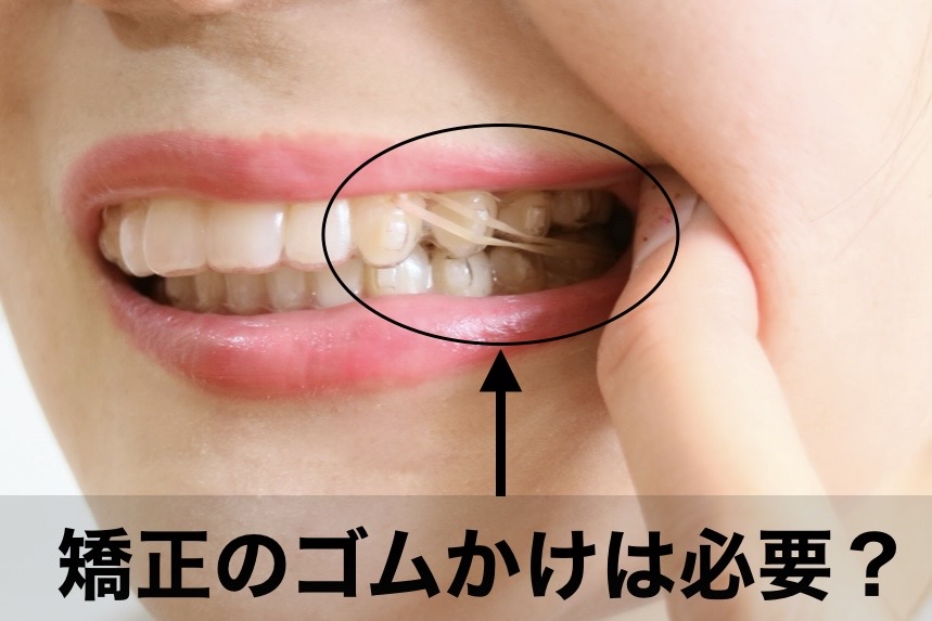 矯正のゴムかけは必要？