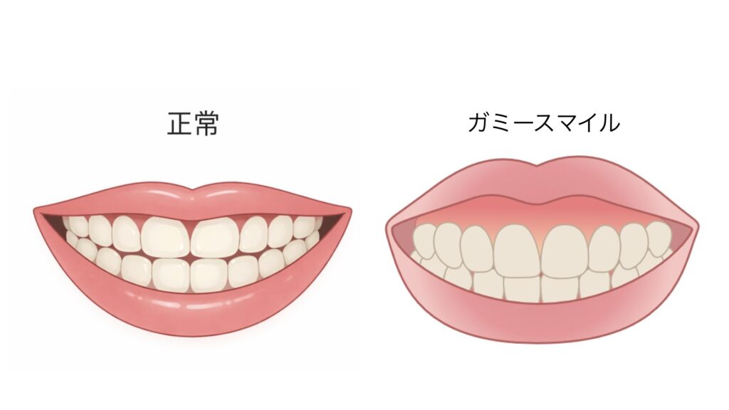 正常な口元とガミースマイルの比較