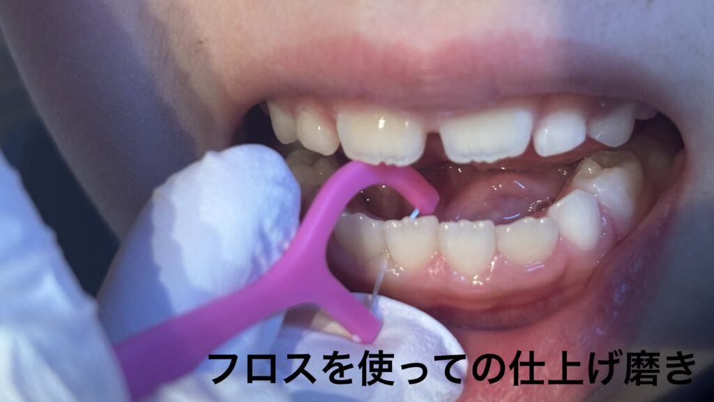 フロスを使っての仕上げ磨き