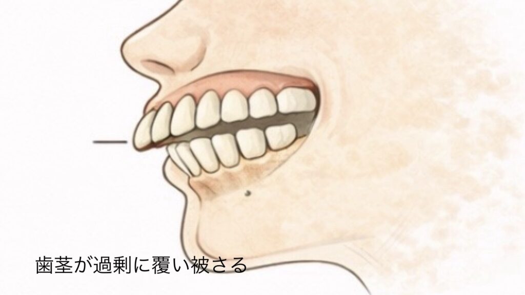 ガミースマイルの主な原因：歯茎が過剰に覆いかぶさる