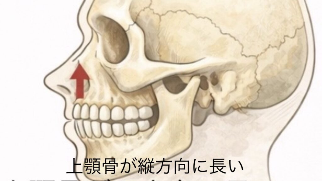 ガミースマイルの主な原因：上顎骨が縦方向に長い