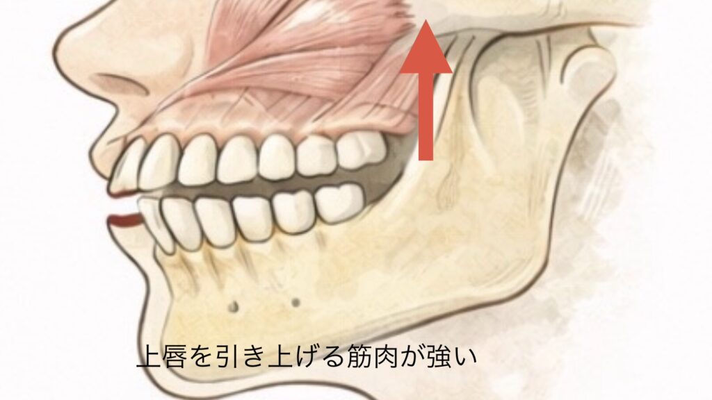 ガミースマイルの主な原因：上唇を引き上げる筋肉が強い