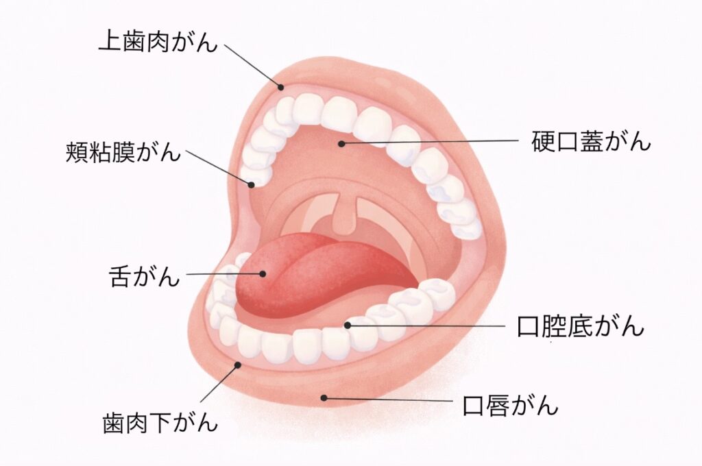 口腔がん