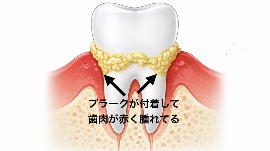歯と歯茎の間にプラークが付着し、歯茎が腫れる