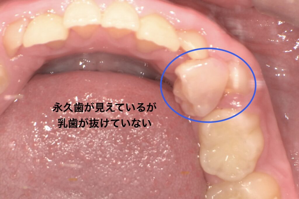 要注意乳歯