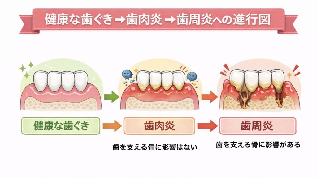 歯肉炎から歯周病への進行図
