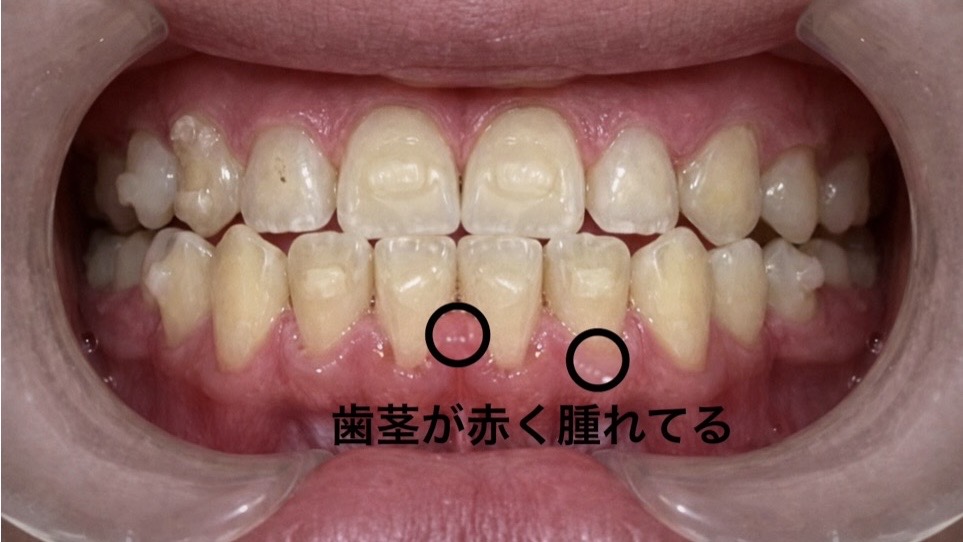 歯ぐきが赤く腫れている様子