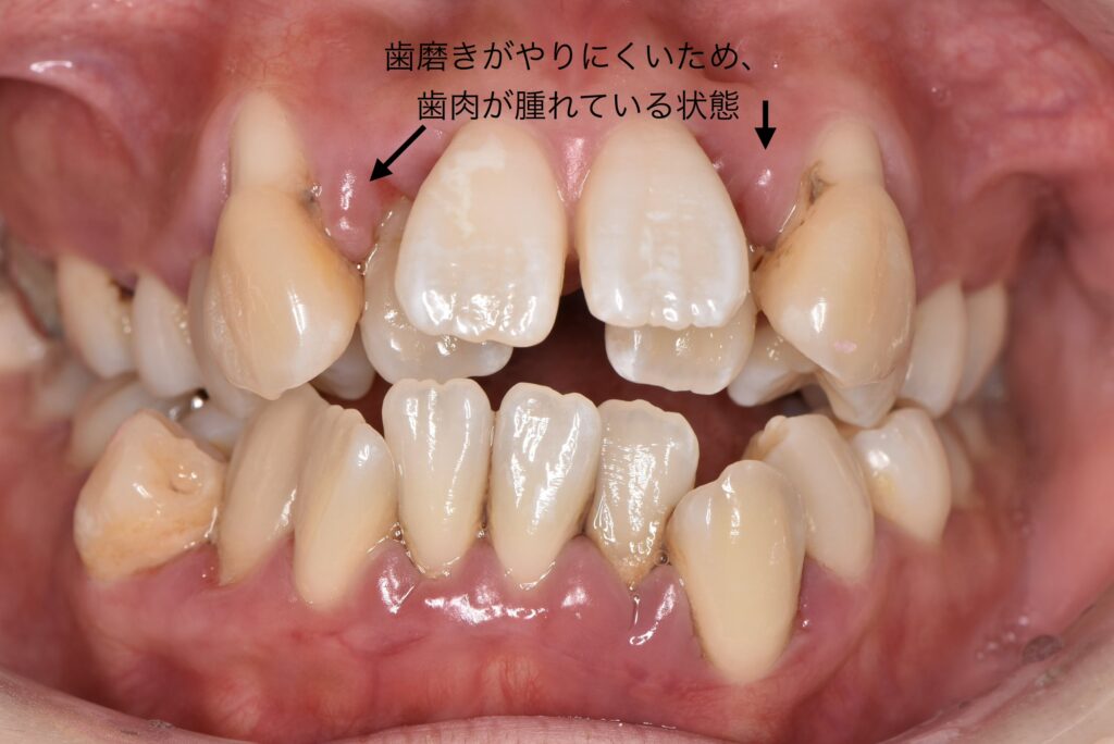 歯磨きがしづらい歯並び