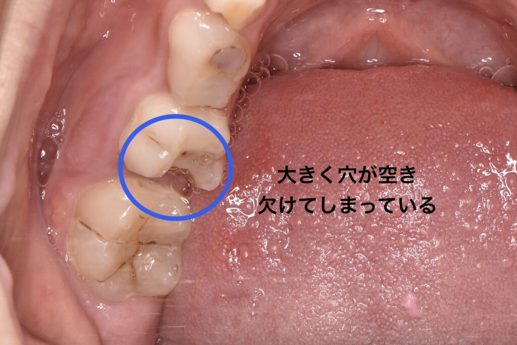要治療のむし歯