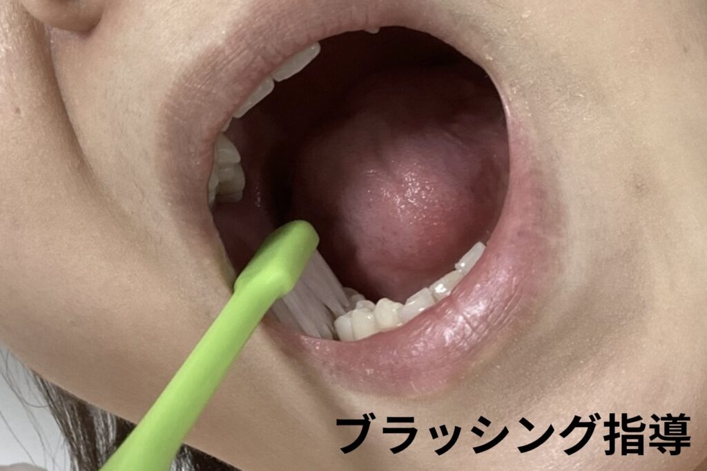 ブラッシング指導