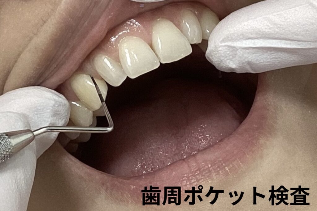 歯周ポケット検査