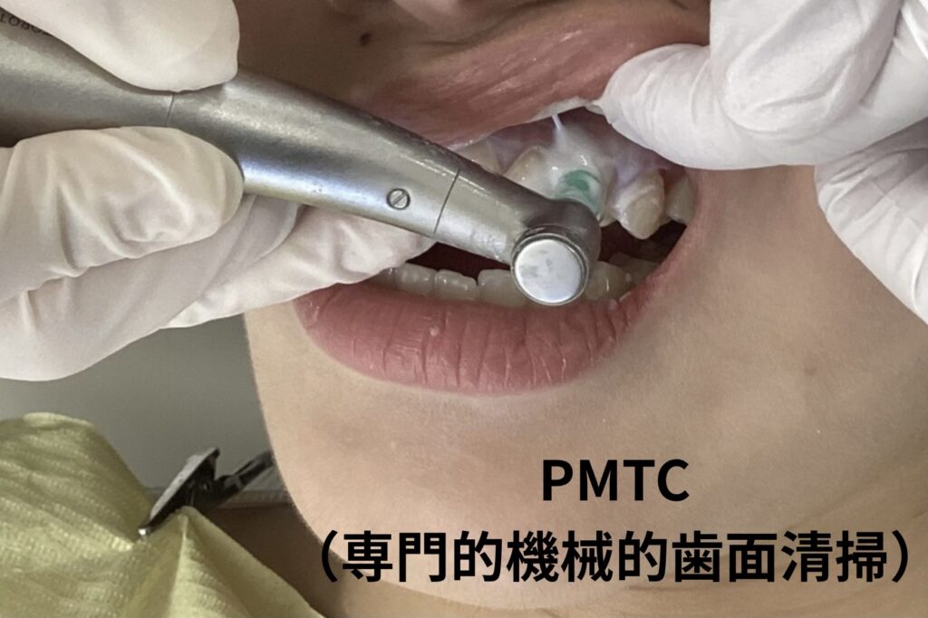 専門的機械的歯面清掃(PMTC)