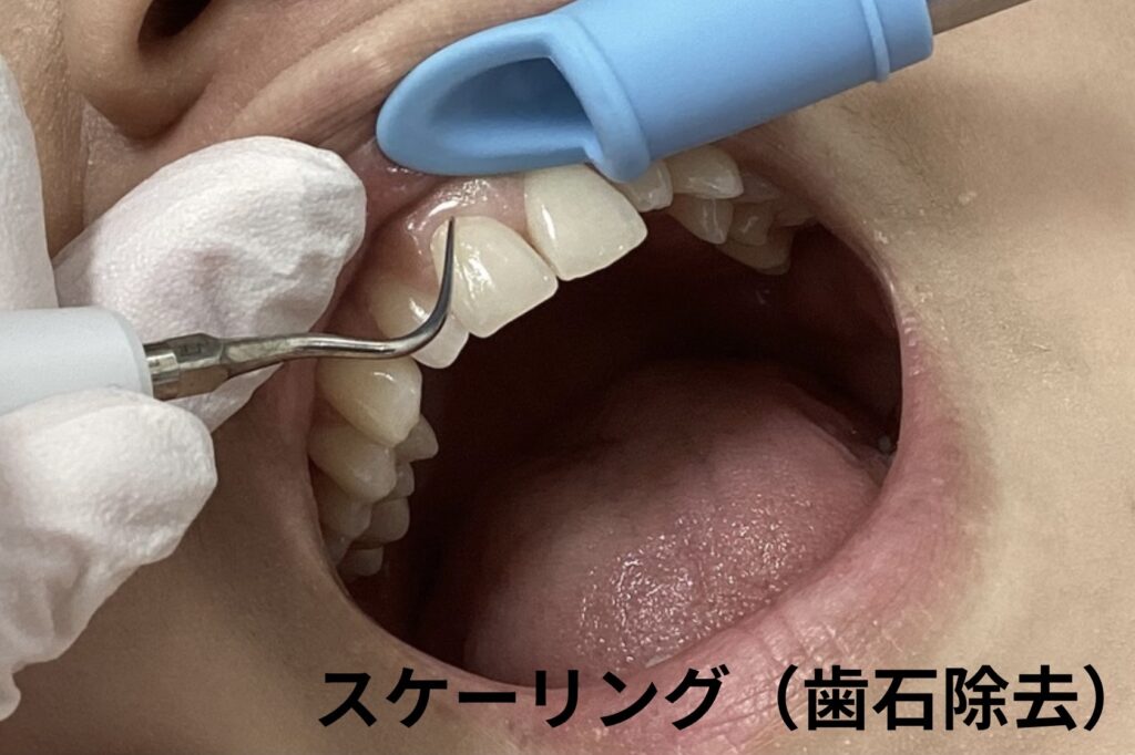歯石除去
