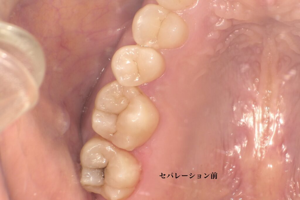 セパレーションリングを装着する前