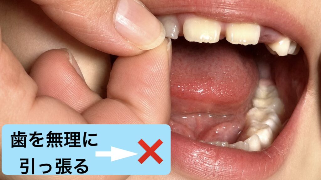 歯を引っ張らないで