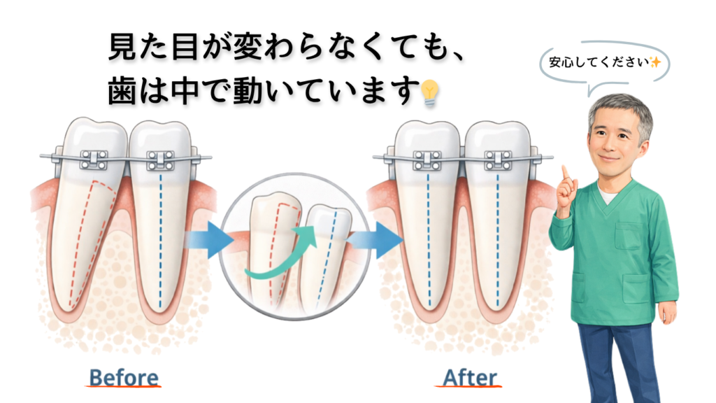 見た目が変わらなくても、歯は中で動いている