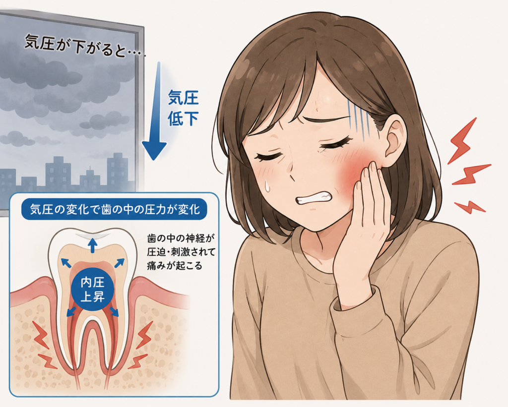 気圧が下がることで歯が痛くなる仕組み