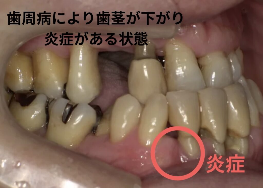 歯周病が進行している