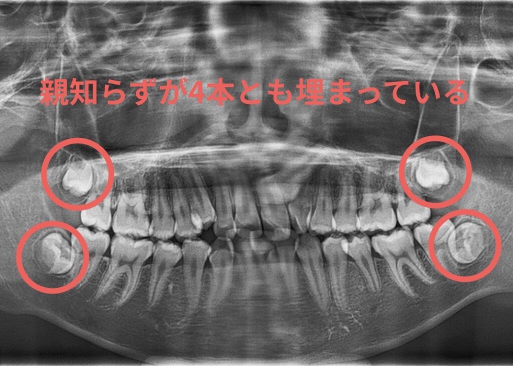 親知らずが埋まっている