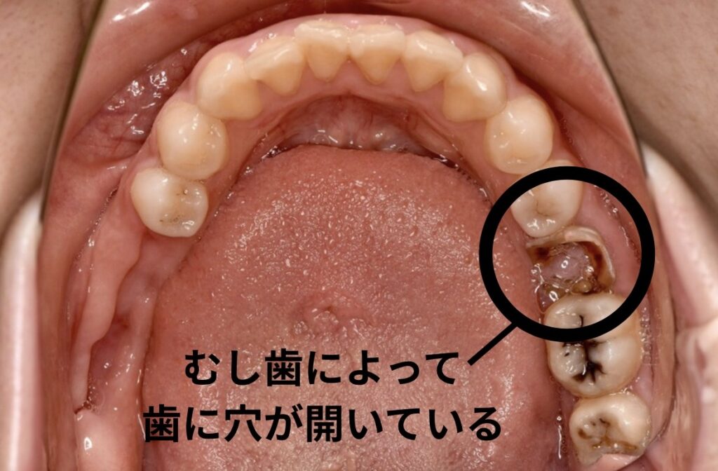 むし歯を放置している口腔内