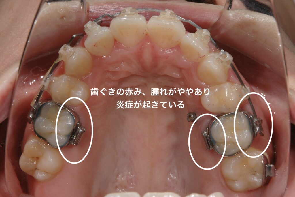 矯正で使用するバンドによる、歯茎の腫れ