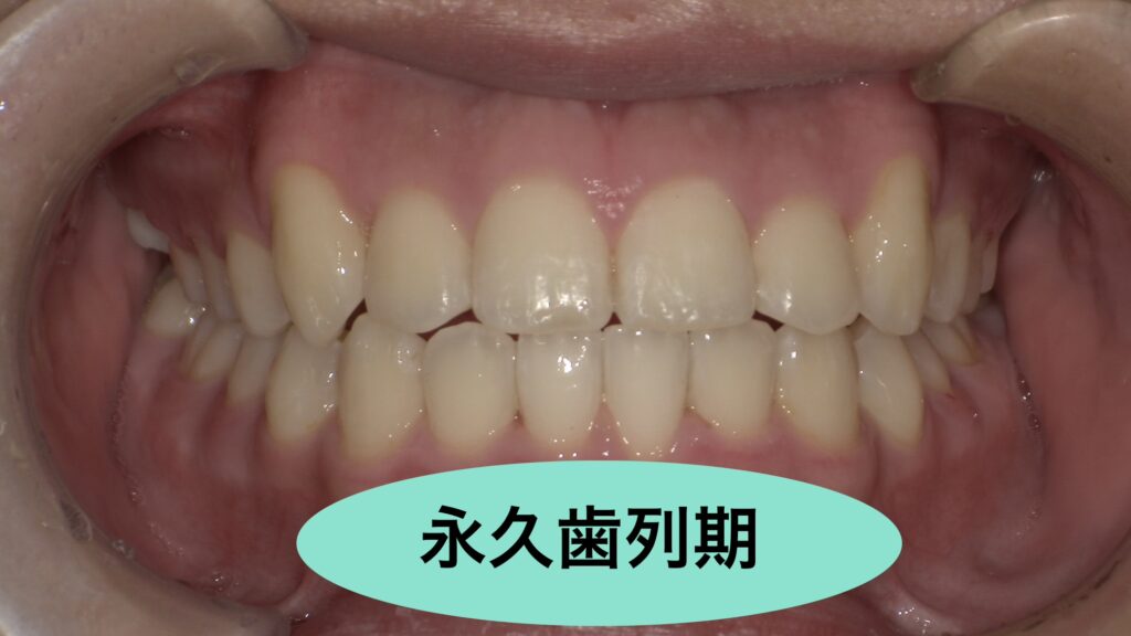 永久歯列期