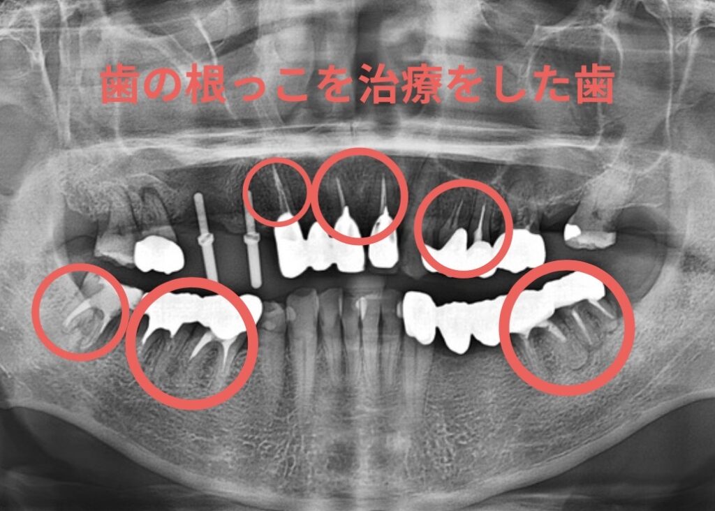 根っこを治療した歯