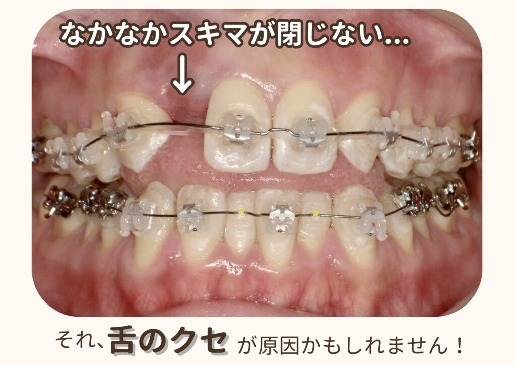 舌癖