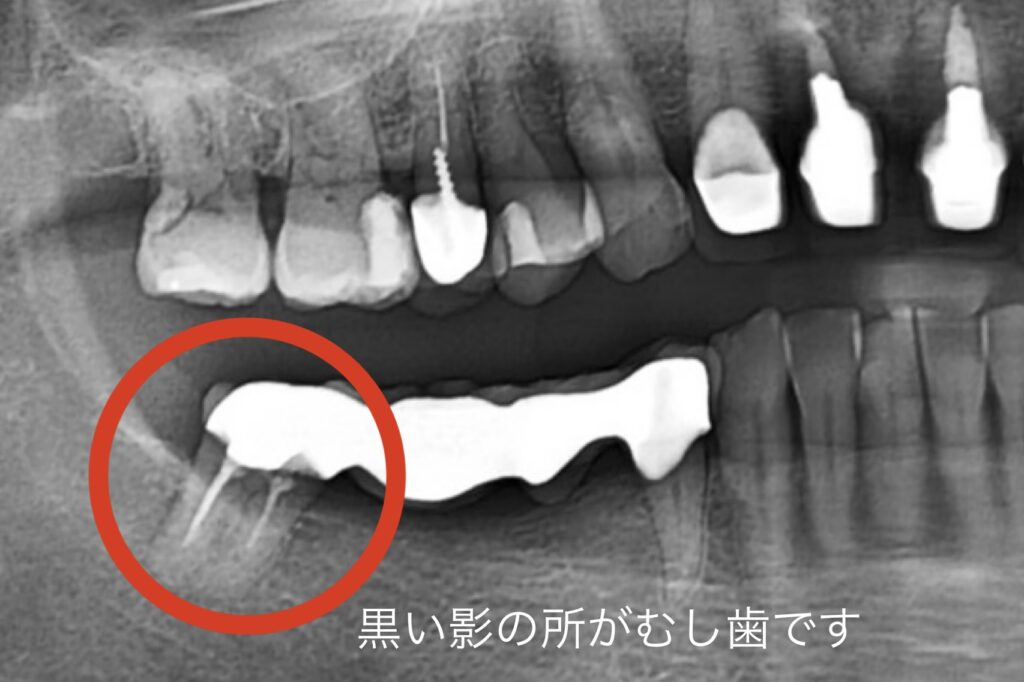 むし歯治療前のレントゲン撮影