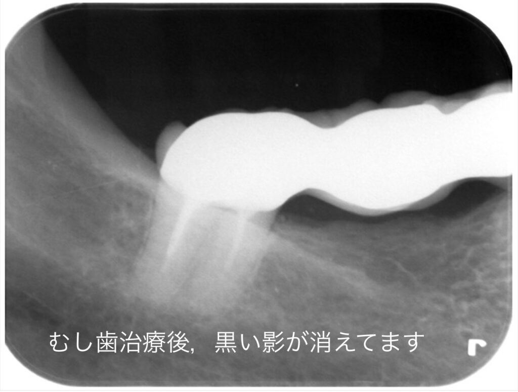 むし歯治療後のレントゲン撮影