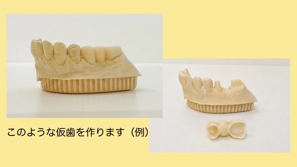 仮歯作成時の模型