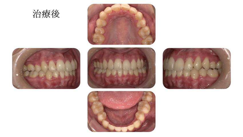 矯正治療開始後