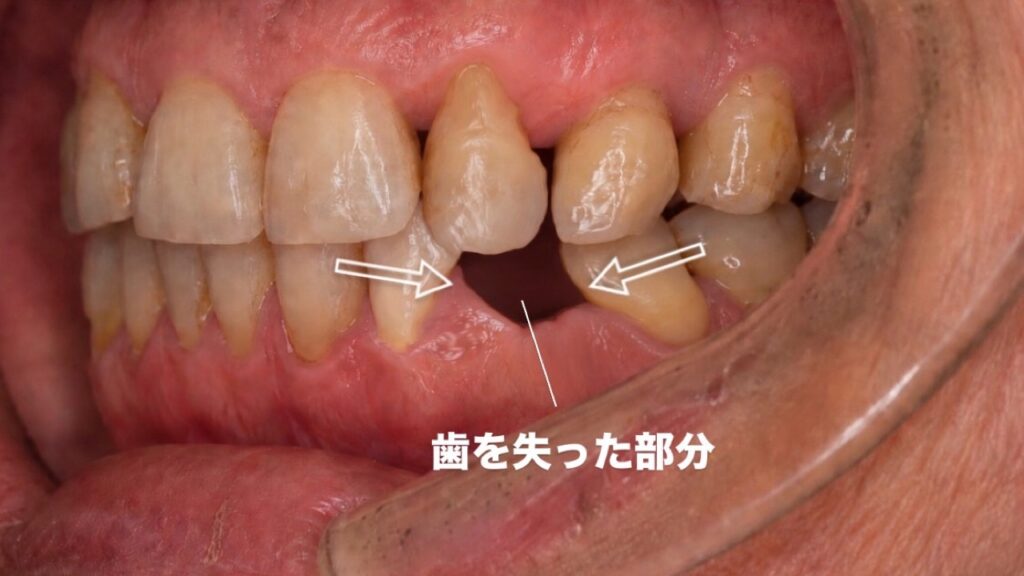 歯を失って、一部の歯に負担が集中してしまう
