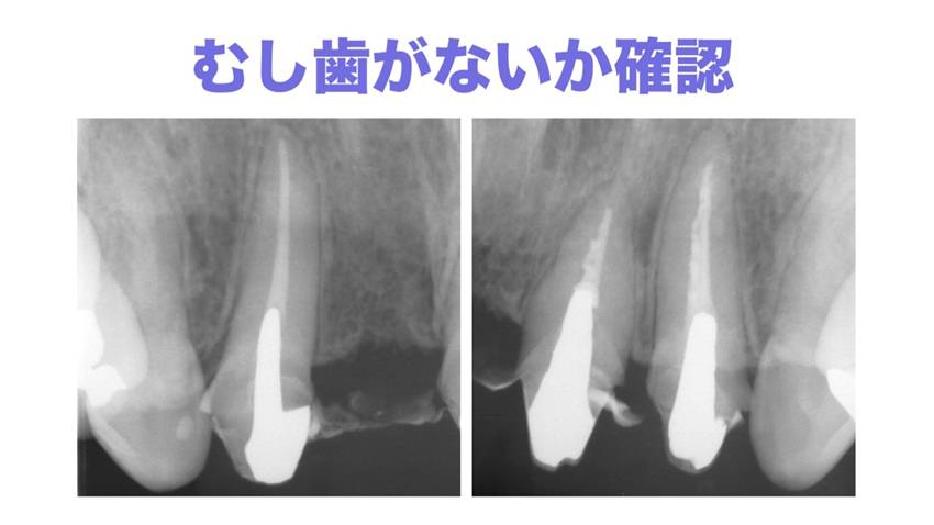 むし歯がないか確認