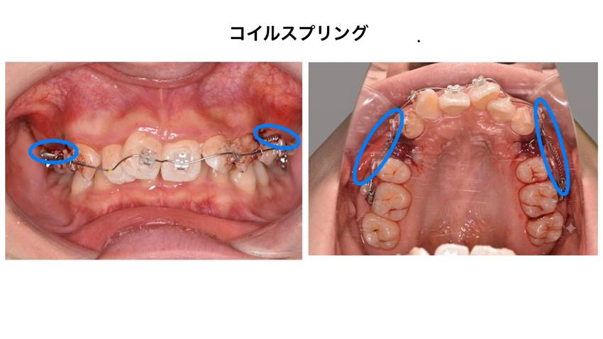 上顎、正面の写真