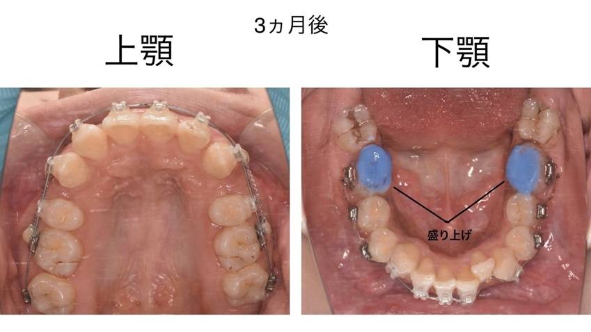 3ヶ月後、上顎、下顎の盛り上げの写真