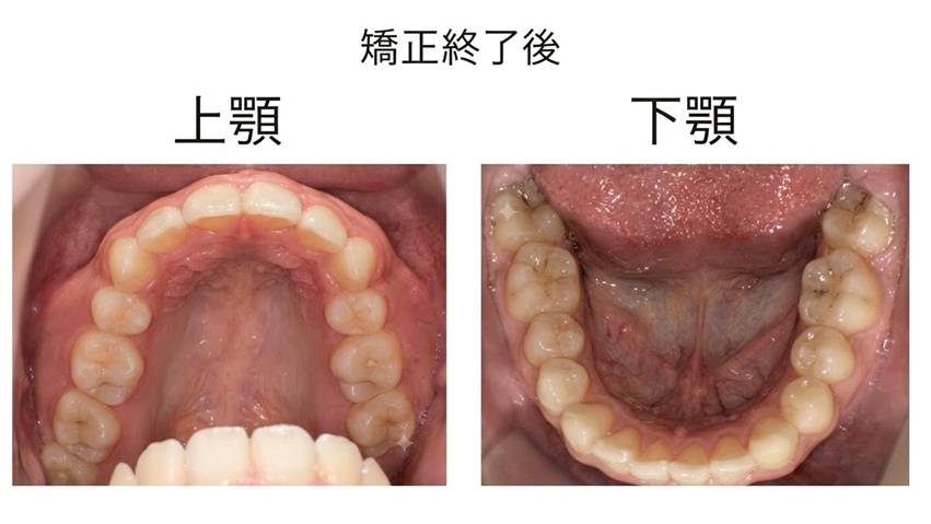 矯正終了後の写真