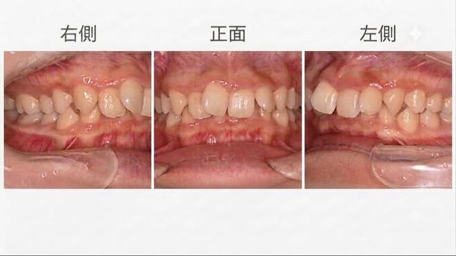 初診時の側方、正面