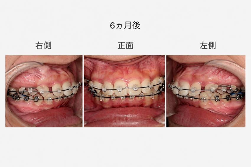 6ヶ月後、側方、正面の写真