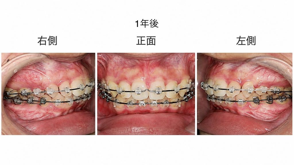 1年後 側方、正面の写真