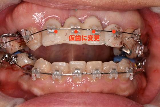 前歯を仮歯に変更