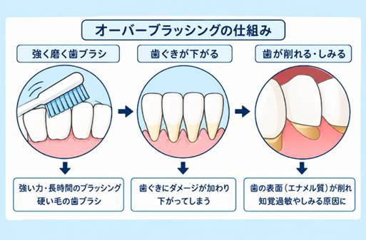 オーバーブラッシングのしくみ