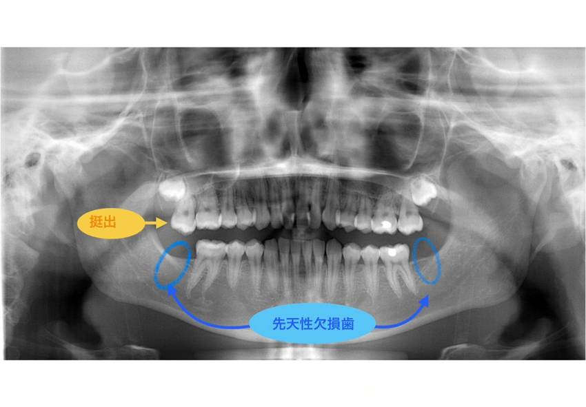 パノラマ
先天性欠損歯
挺出