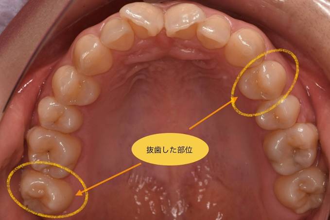 抜歯した部位