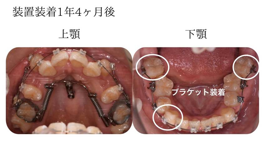 矯正装置装着1年4ヶ月後