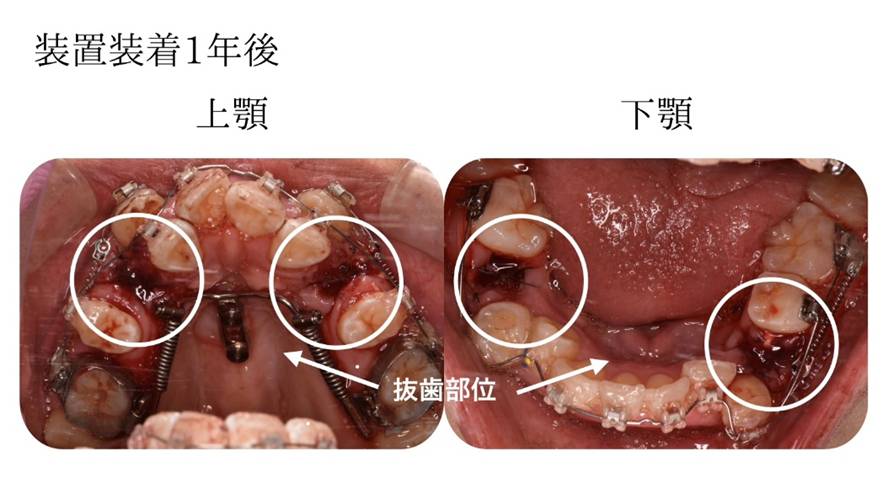 矯正装置装着1年後