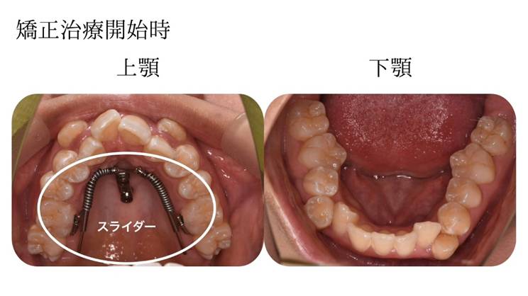 矯正治療開始時