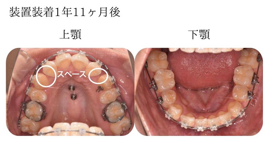 1年11ヶ月後